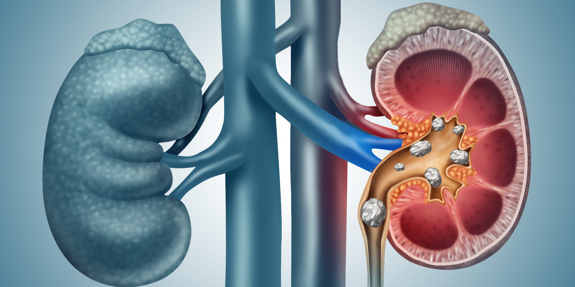 kidney stones natural treatment olive oil