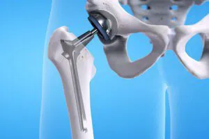 What is Hip Replacement?