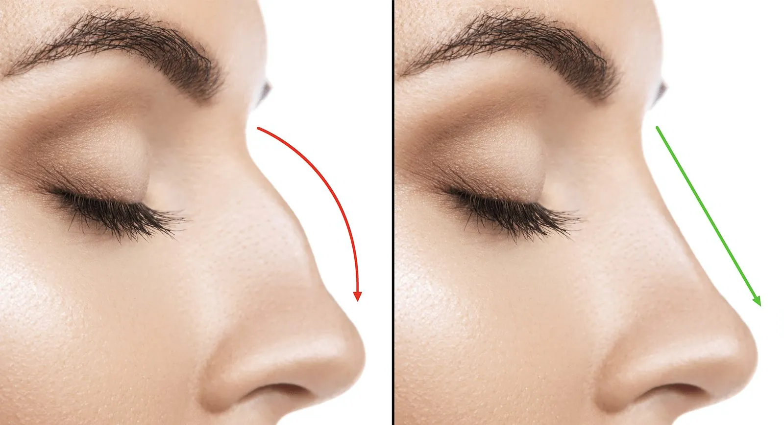 Rhinoplasty Revision