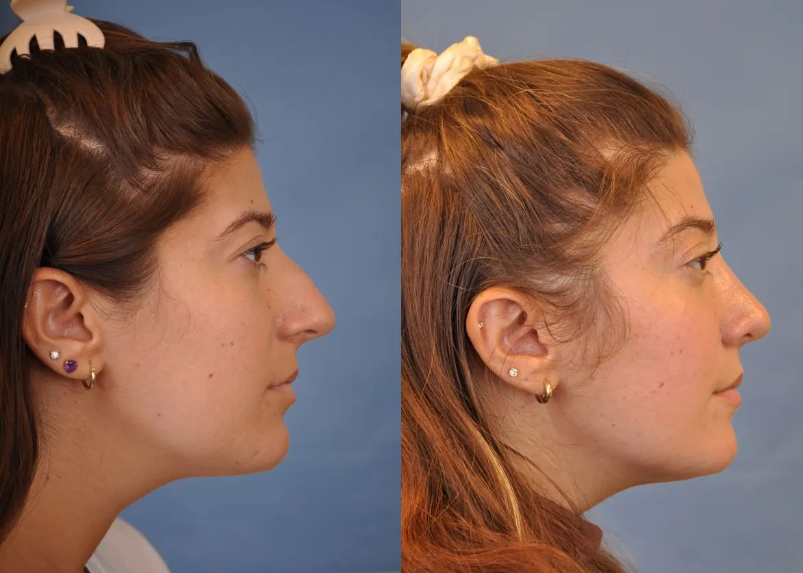 af functional and cosmetic rhinoplasty right