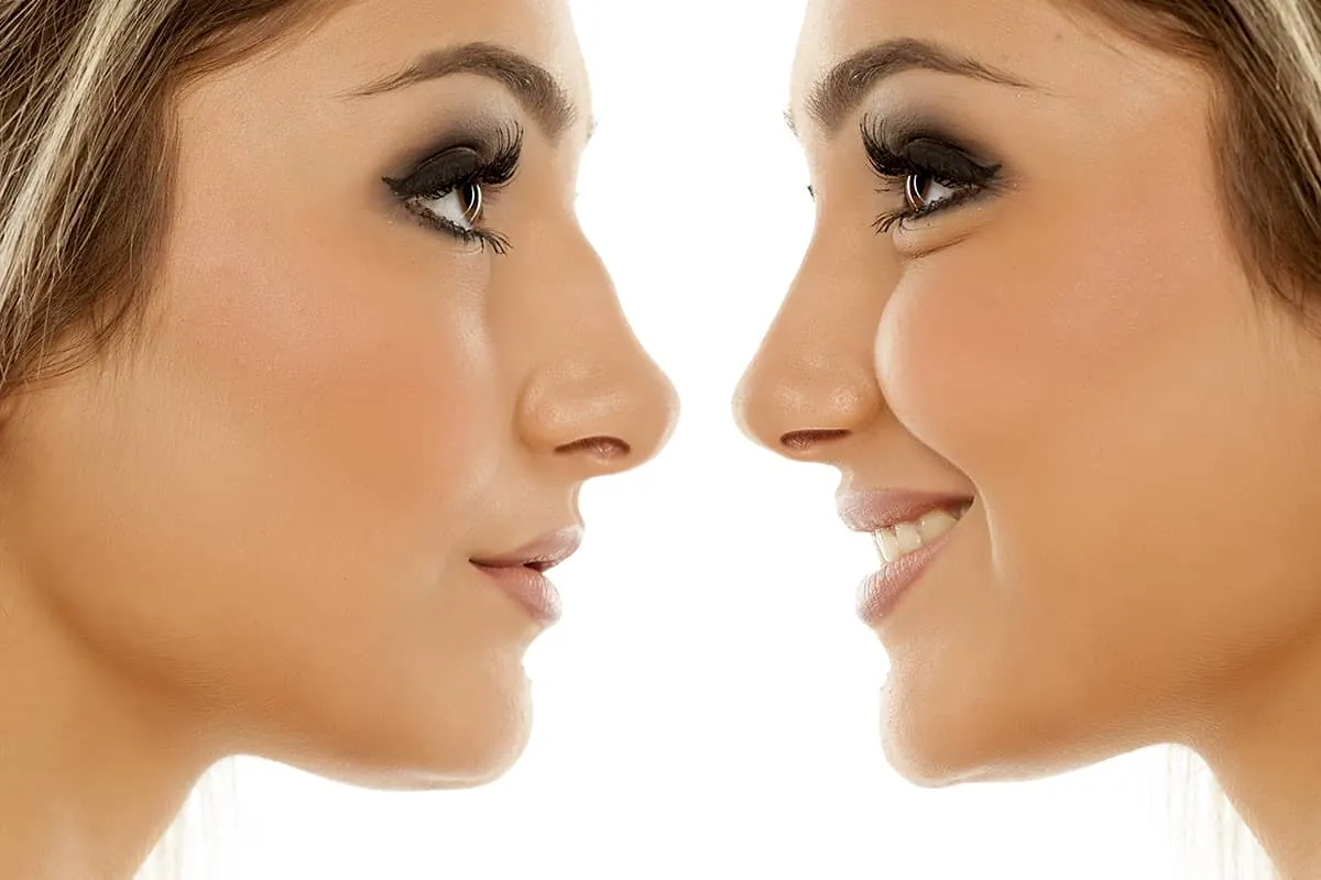 nose job changes dr naderi virginia