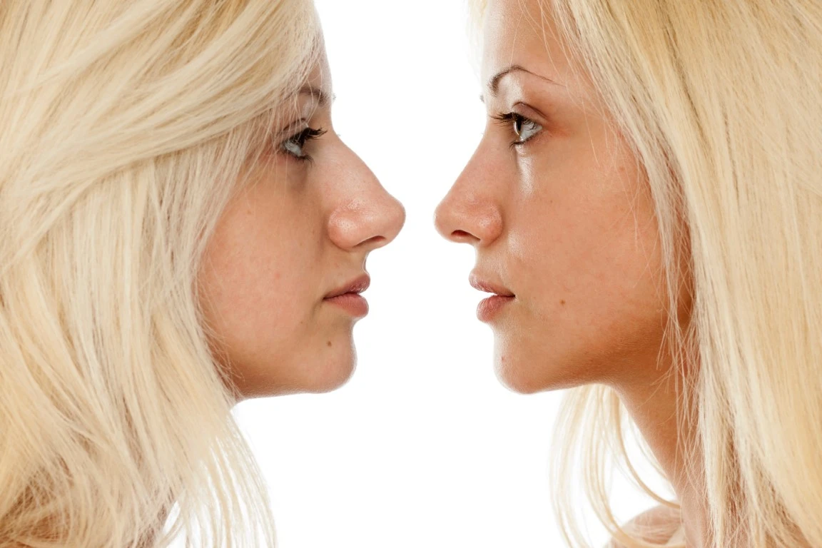 nose surgery before and after should I get a nose job rhinoplasty nose job facts best plastic surgeons