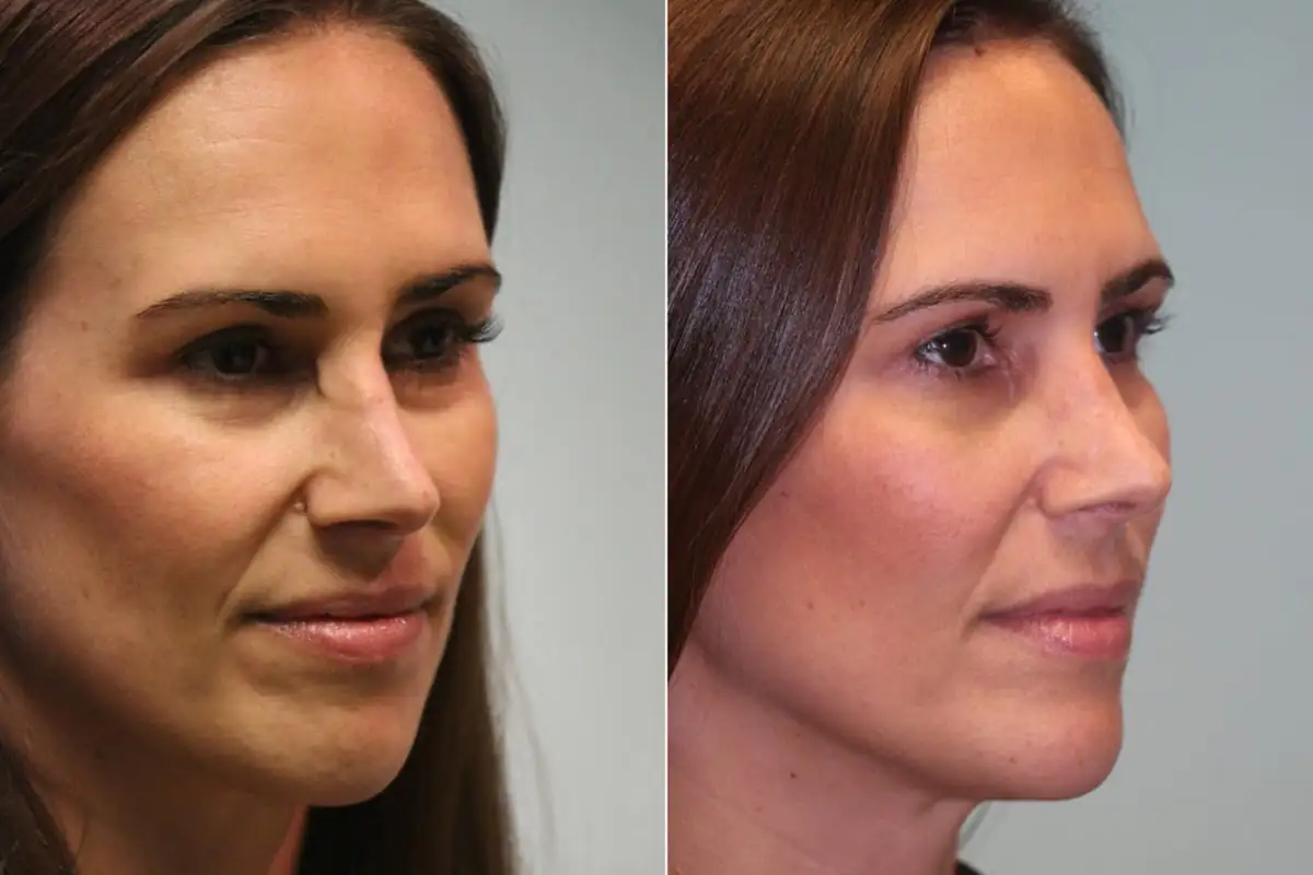 revision rhinoplasty virginia