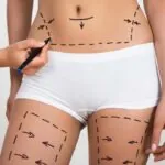 Liposuction ve Diyet Arasındaki Farklar Nelerdir?