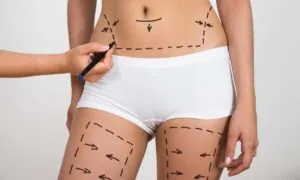 liposuction ile diyet arasındaki farklar