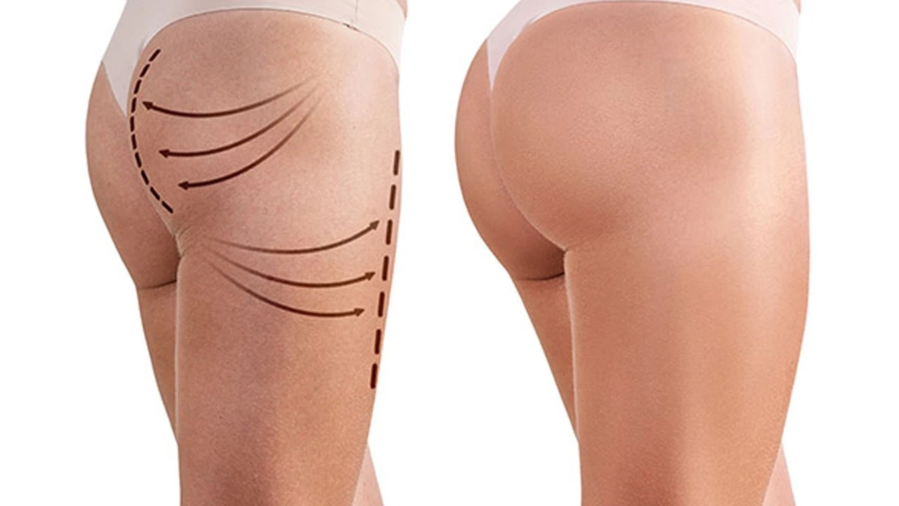 ankara popo estetigi