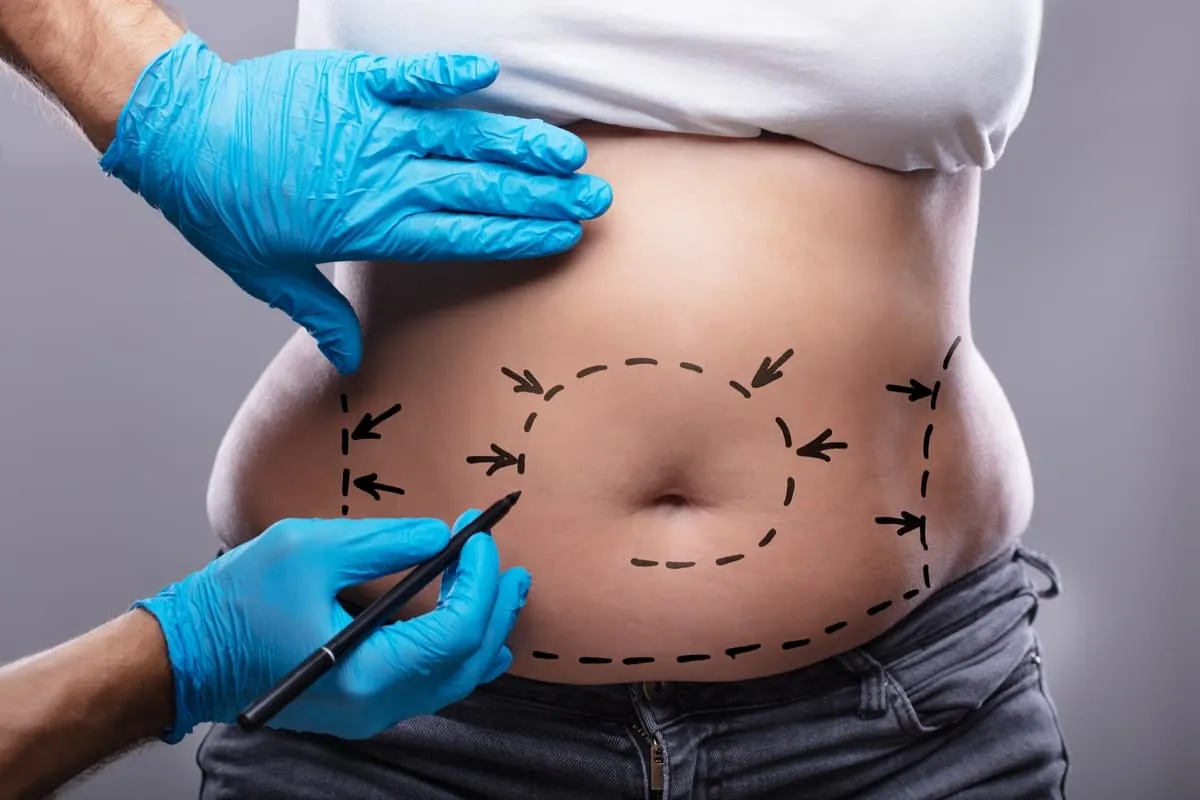 karin germe abdominoplasti 31612 b
