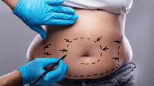 Liposuction, Yağ Aldırma
