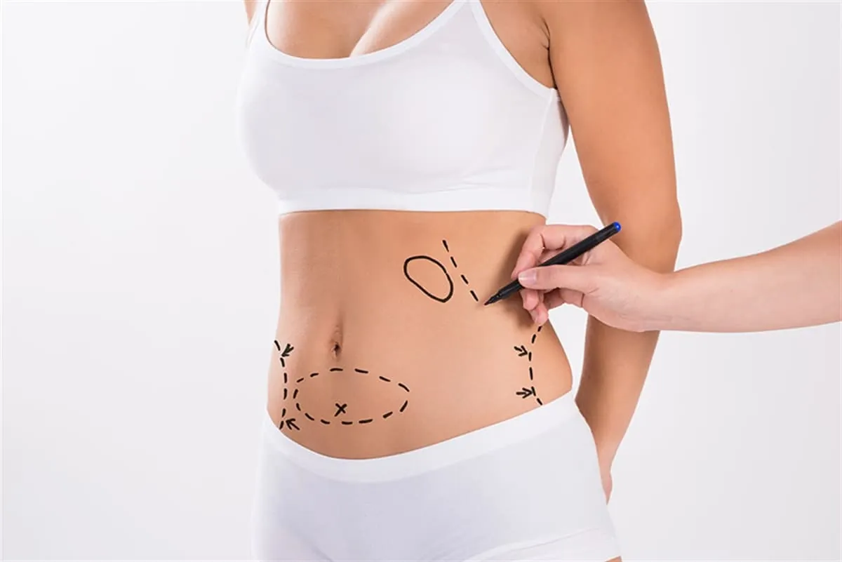 Liposuction ile Yağ Aldırma