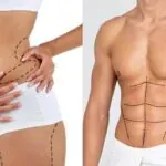 Liposuction ile Yağ Aldırma Nasıl Yapılır?