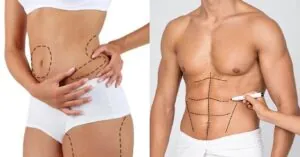 Liposuction ile Yağ Aldırma