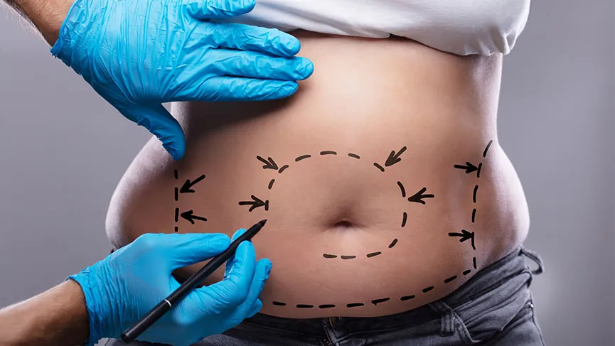 Liposuction Ameliyatı 1 Liposuction, Yağ Aldırma