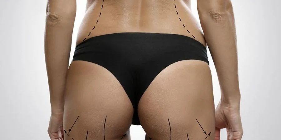 brazilian butt lift bbl 475114402