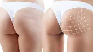 BBL Sonuçları Kalıcı mı? Yağ Hücreleri Zamanla Kaybolur mu?