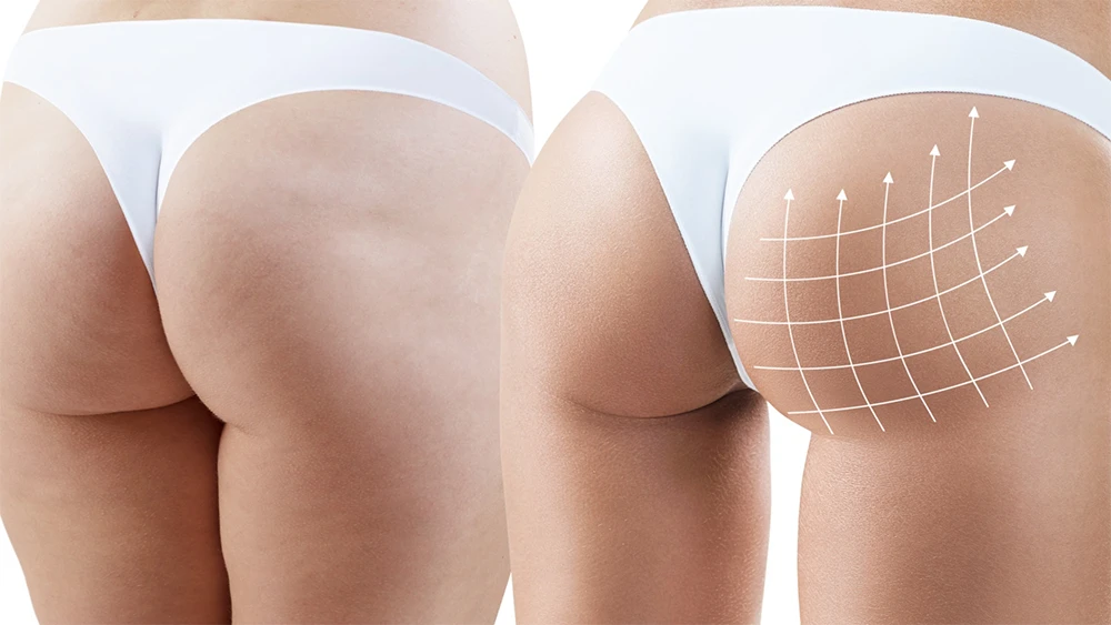 BBL Sonuçları Kalıcı mı? Yağ Hücreleri Zamanla Kaybolur mu?