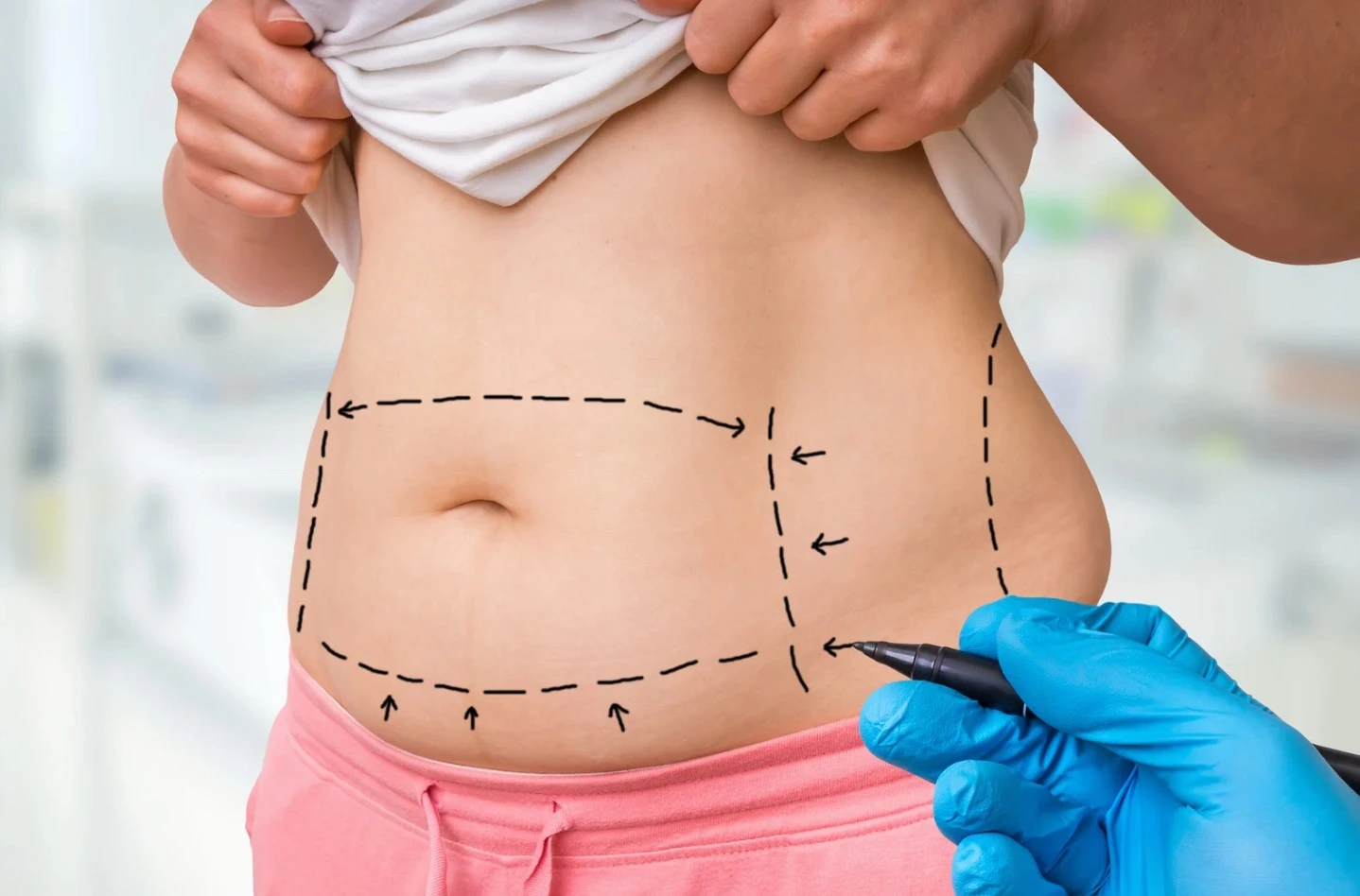 Liposuction Sonrası Ödem ve Morluk Ne Kadar Sürer? 3 360 Derece Liposuction 1
