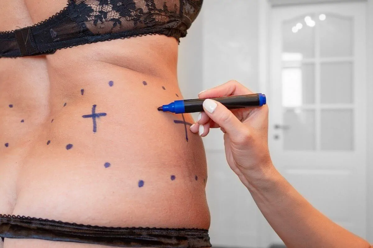 Liposuction Sonrası Ödem ve Morluk Ne Kadar Sürer? 1 Liposuction Sonrası