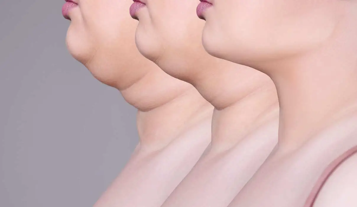 Liposuction Sonrası Ödem ve Morluk Ne Kadar Sürer? 2 gidi lipo 2