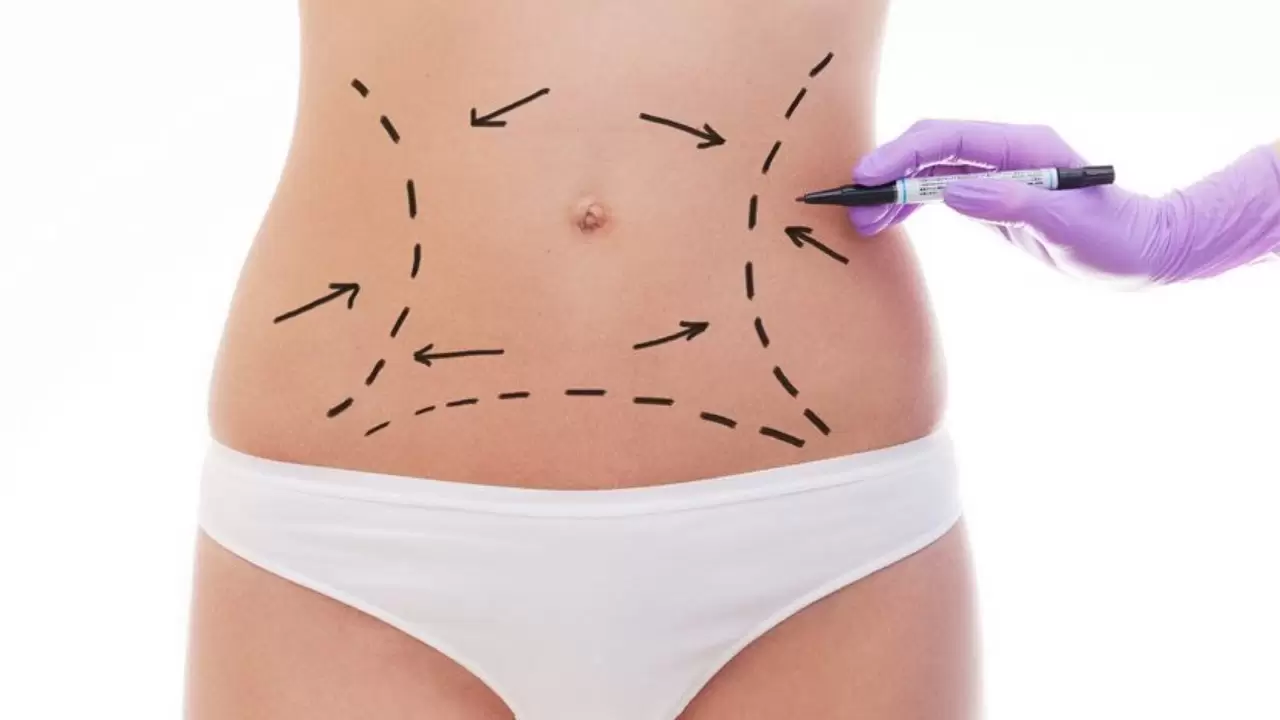 Liposuction Sonrası Ödem ve Morluk Ne Kadar Sürer? 5 lazer
