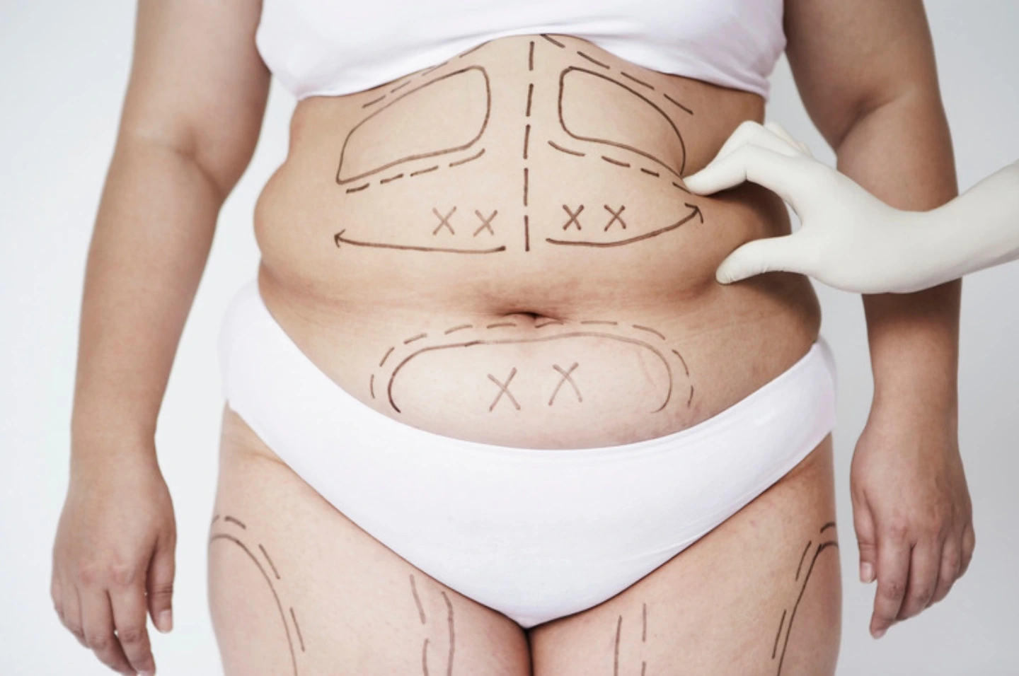 Liposuction Sonrası Kilo Alınırsa Ne Olur? Zararlı mıdır? 4 360 Derece Vaser Liposuction 1