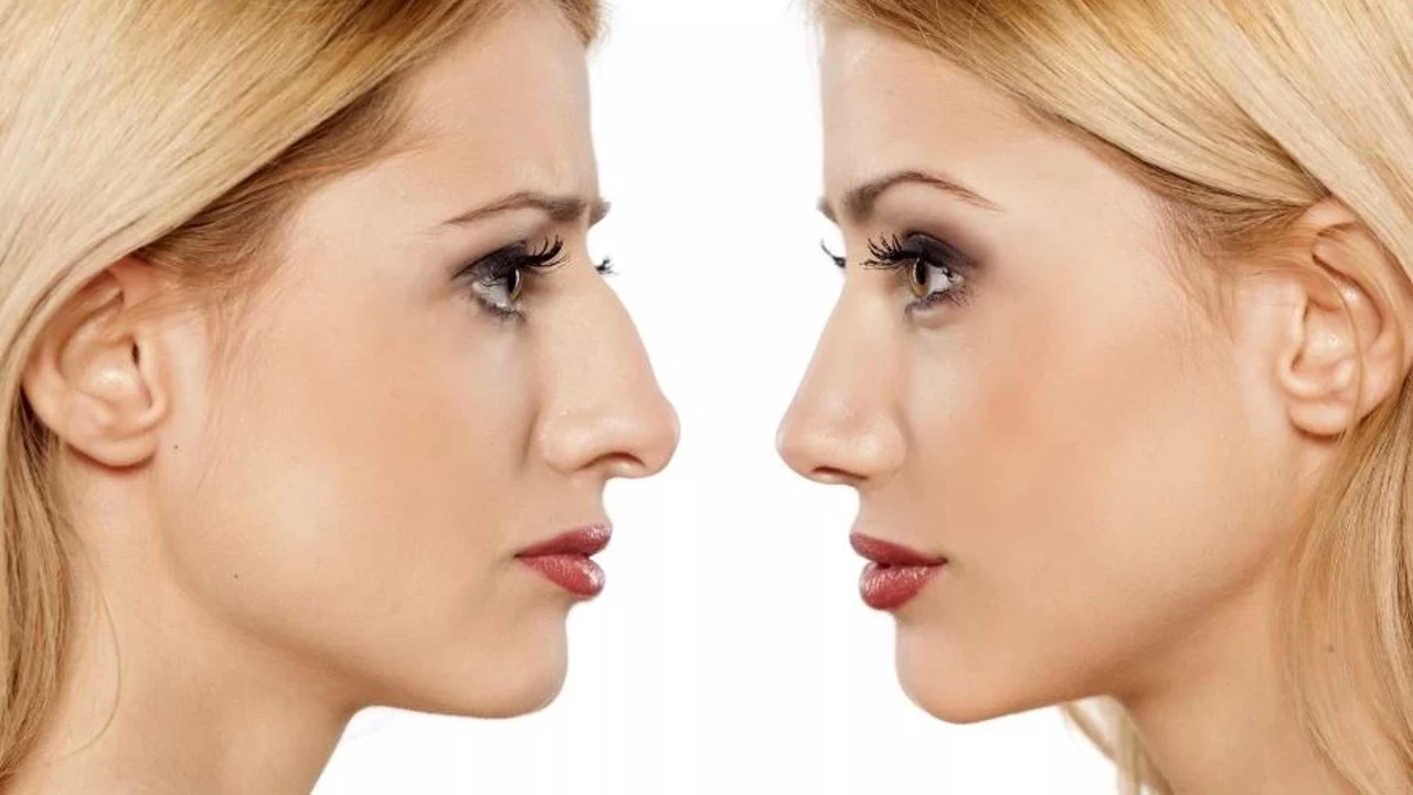 Septorinoplasti Nedir ve Kimlere Uygulanır? 2 892209