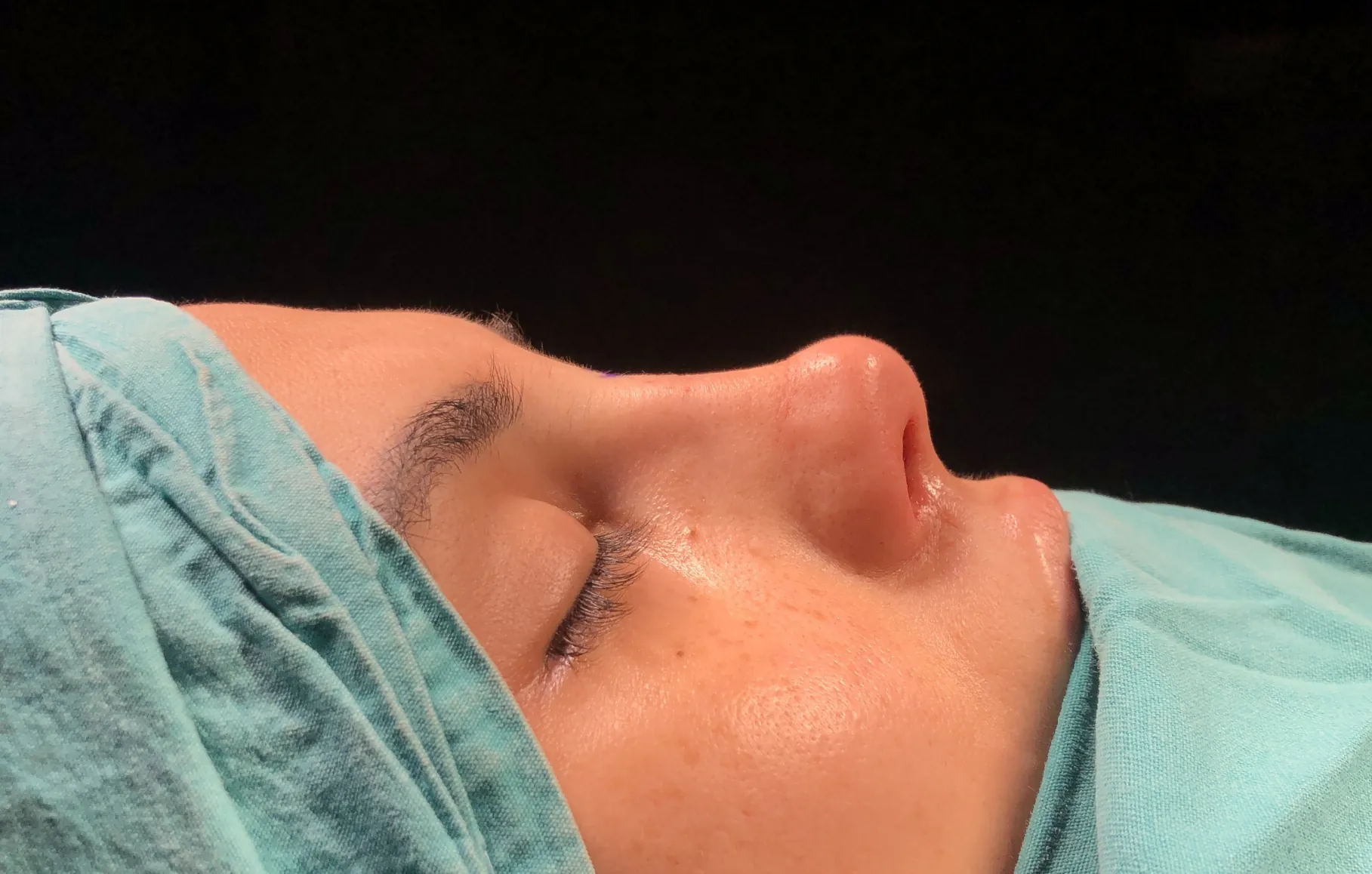 Septorinoplasti Nedir ve Kimlere Uygulanır? 3 IMG 4711 scaled e1616274946187