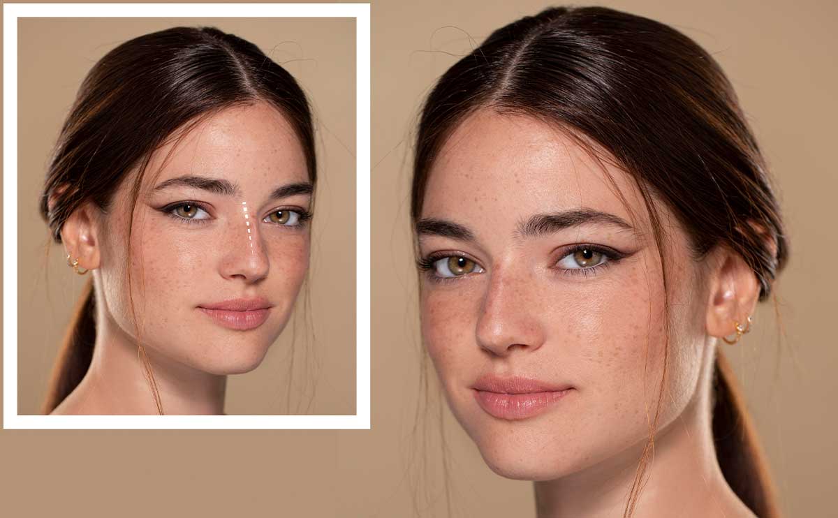 acik kapali rinoplasti