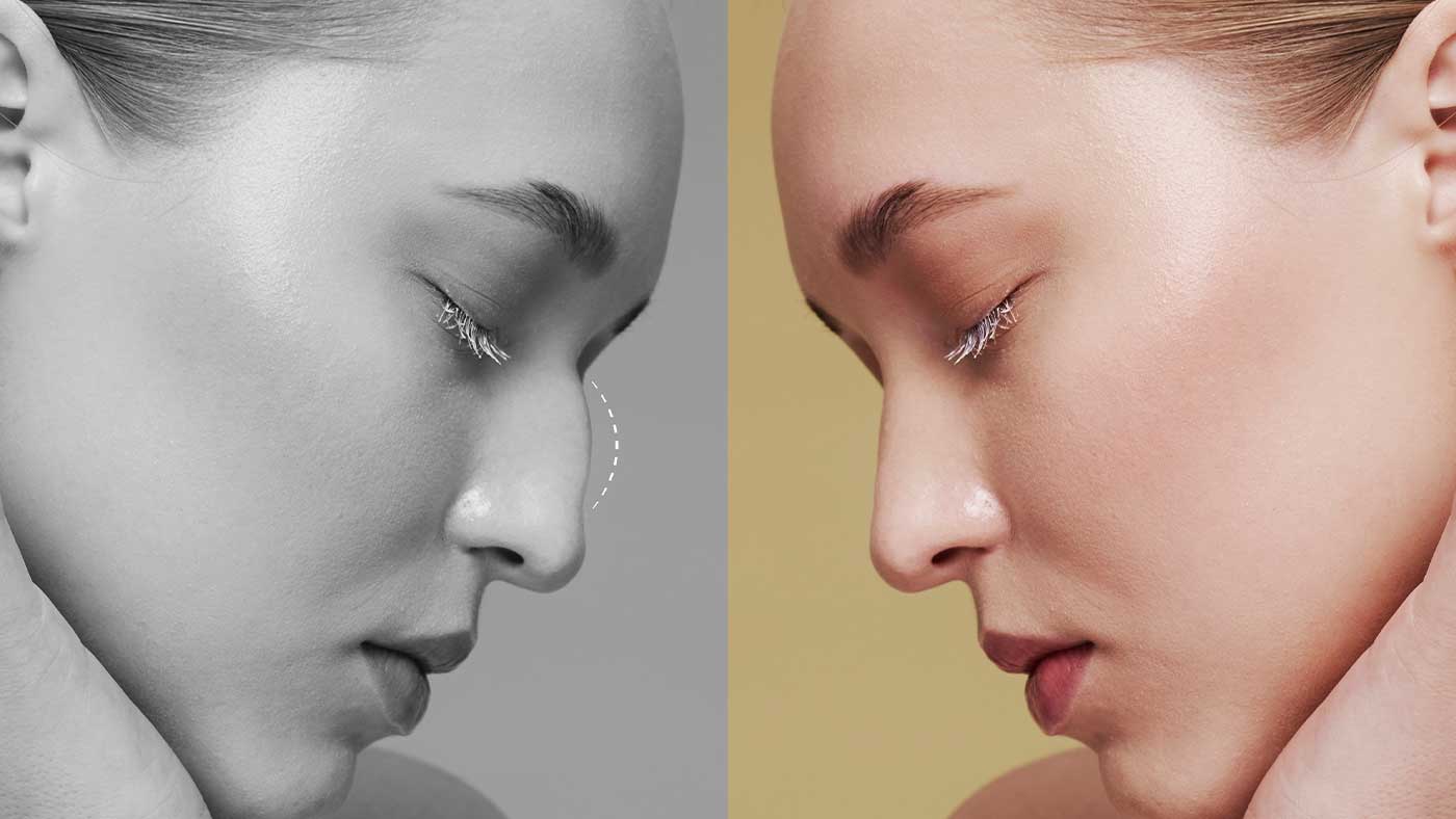 burun estetigi icin dogru aday misiniz