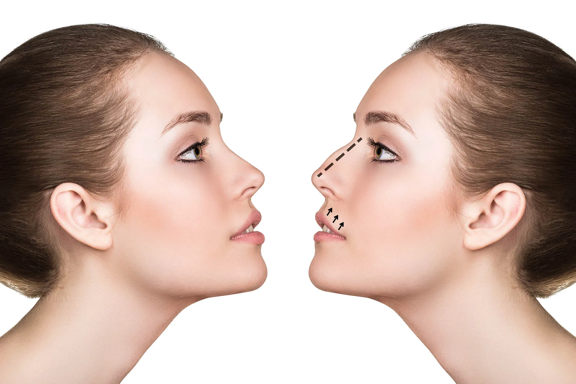 Rinoplasti Sonrasında Burun Ucu