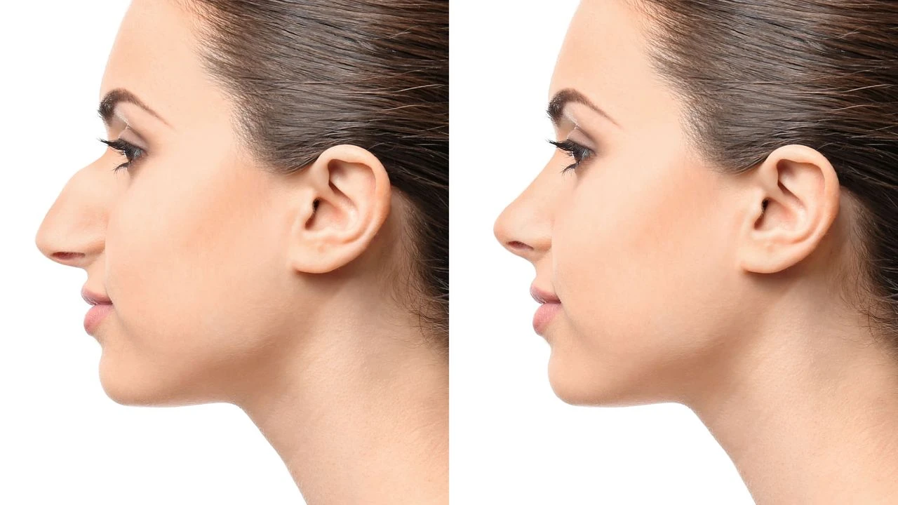 080637296rhinoplasty before after