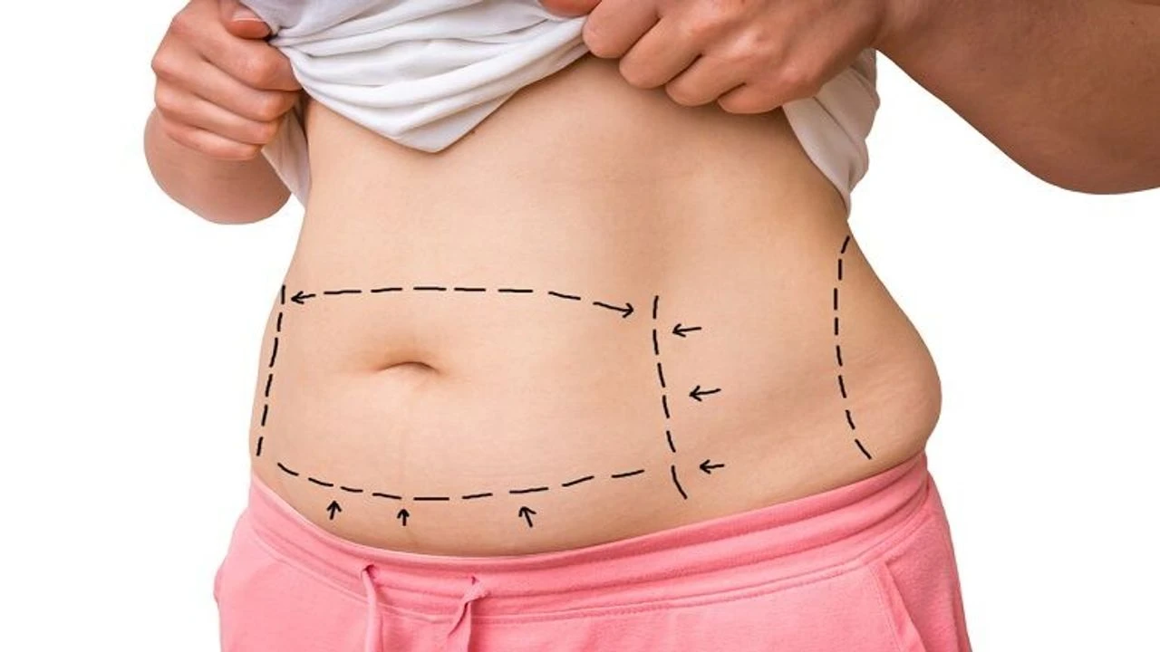 Liposuction Sonrası Kalıcı Sonuçlar İçin Ne Yapmalısınız? Beslenme, Spor ve Takip Rehberi 2 liposuction 2