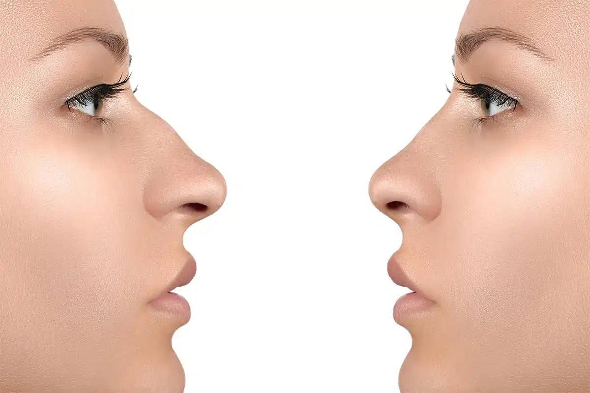 Rinoplasti Planlarken Bilmeniz Gerekenler: Cerrah Seçimi, Teknik ve Beklenti Yönetimi 2 rhinoplasty can fix crooked nose