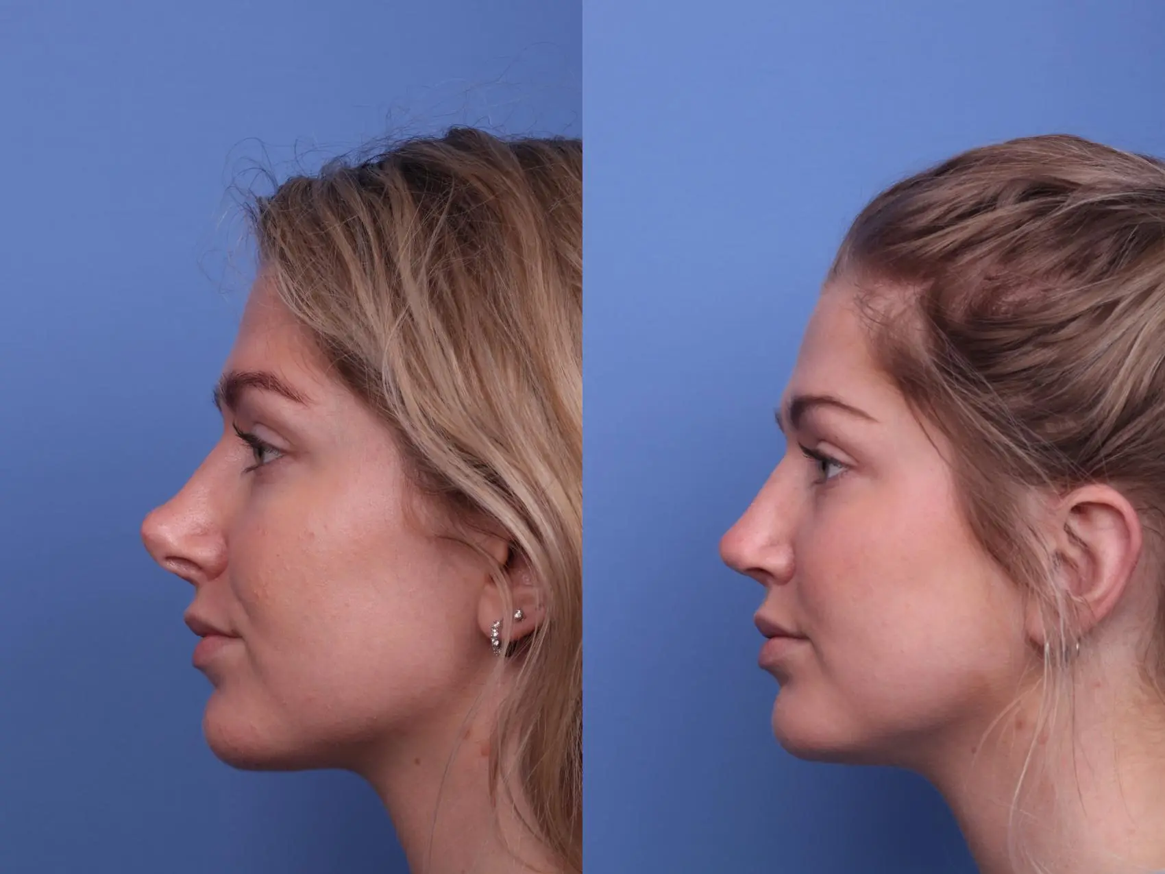 Rinoplasti Planlarken Bilmeniz Gerekenler: Cerrah Seçimi, Teknik ve Beklenti Yönetimi 5 rhinoplasty revision 385 left side detail