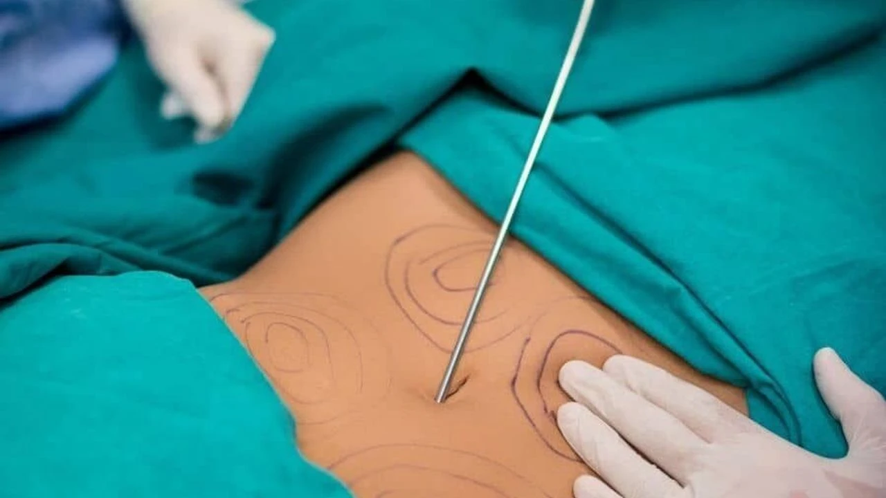 Liposuction Sonrası Kalıcı Sonuçlar İçin Ne Yapmalısınız? Beslenme, Spor ve Takip Rehberi 4 vaser liposuction nedir 1