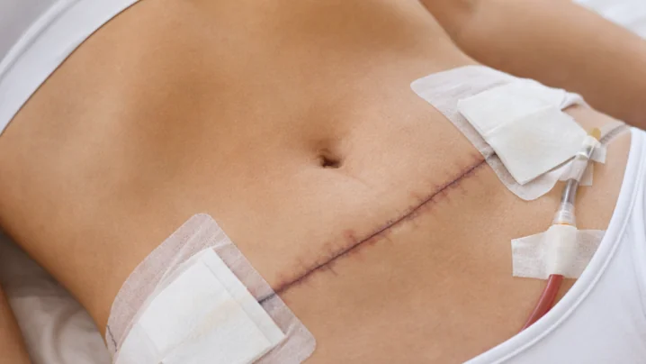 Karın Germe ile Doğum Çatlakları Geçer mi?