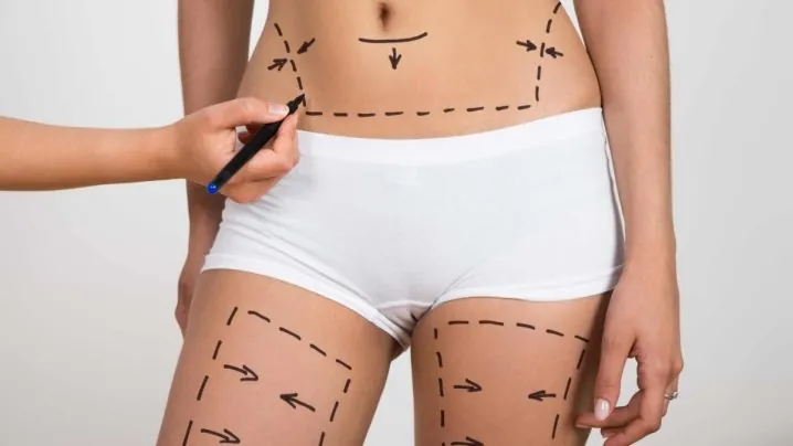 liposuction ile diyet arasındaki farklar