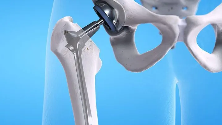 What is Hip Replacement?