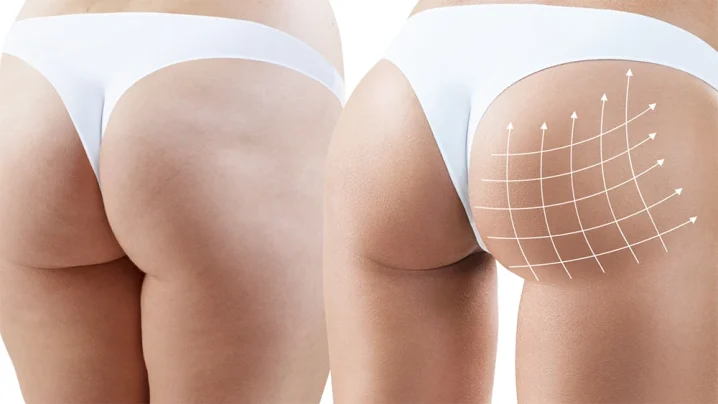 BBL Sonuçları Kalıcı mı? Yağ Hücreleri Zamanla Kaybolur mu?